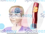 Blocked artery, clot, stroke, thrombus